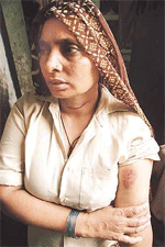 Om Kali displays a wound after she was attacked by a monkey like creature in Delhi.