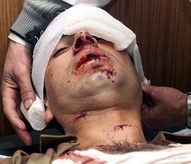 An injured policeman has his head bandaged after a grenade attack in Srinagar on Tuesday. 