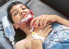 Javed, a boy injured in the Doda blast, is seen lying in an ambulance at the Air Force Station in Jammu