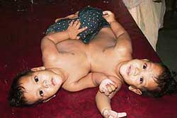 The 10-month-old conjoined twins, Ram and Lakshman before the surgery to separate them at Raipur Medical College on Tuesday. 