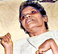 Aruna Shanbaug