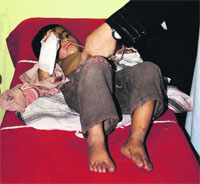 Farzana, one of the injured in firing by Pakistani troops, being treated at a Poonch hospital. 