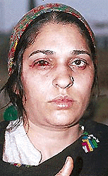 Harpreet Kaur, who was beaten up by robbers at Bartana village on Tuesday. — A Tribune photograph