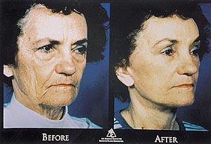 Cosmetic Surgery on Discovery channel