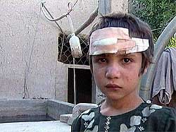 A girl injured during a US bombing raid