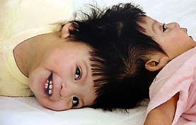 Eleven-month-old conjoined twins from Guatemala