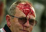 Blood pours from a fan