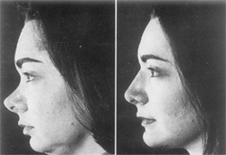 Before and after cosmetic surgery