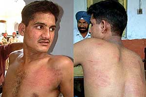 D.C. Pandey, a driver with the Army, shows the marks on his chest (left) and back (right) allegedly caused by beating up by police personnel at City police station in Bathinda on Monday