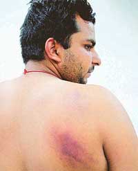 Leading fireman Shiv Kumar posted at the Dera Bassi fire station, show his injury marks