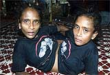 Conjoined twins