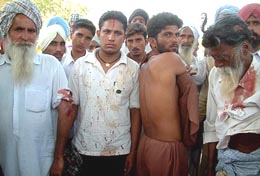 Farmers show their injury marks in Bathinda