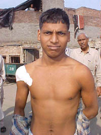 A youth who was bitten by a monkey in Ludhiana on Tuesday. 