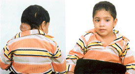 Amritpal Singh, a victim of encephalocele, awaits help for his treatment