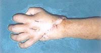Post-operation snaps of a four-year-old childs stitched hand. 