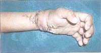 Post-operation snaps of a four-year-old childs stitched hand. 