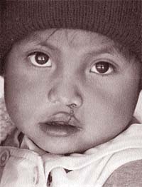 A child suffering from a cleft palate condition