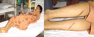 Raj Vansh Kaur shows injuries inflicted with hot iron rods on her legs allegedly by her in-laws. 