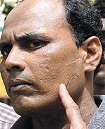 Subhash Bhaskar Nair, an inter-state gangster and contract killer involved in over 20 cases, points to the scar left by plastic surgery on his face
