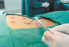 Insertion of screws through small incisions in the back of 15-year-old Sonu during surgery at the Government Medical College and Hospital in Sector 32 of Chandigarh on Tuesday.