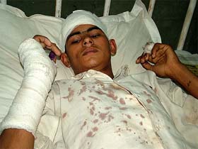 Rajeev, 14, a mentally challenged boy, lying in Agroha Medical College and Hospital after being severely beaten for stealing mausmis