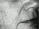 Before laser resurfacing