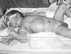 The scalded skin syndrome child before