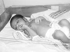 The scalded skin syndrome child after
