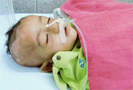 Little Rahul under treatment at the Christian Medical College and Hospital in Ludhiana