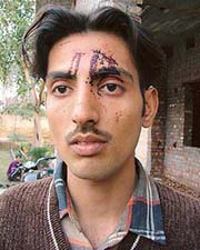 Bus driver Jatinder Singh, who was injured in an attack by students opposite Bus Stand, Ludhiana, on Wednesday. 