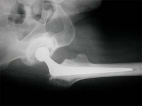 X-ray showing hip replacement surgery where the head of femur has been fused with the shaft through an artificial stem
