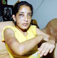 Sonia Sharma (19) from India shows her injuries after she was tortured by her employer in northern Penang state on Sunday.