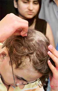 Sahil Sodhi shows his head after a boy allegedly rubbed acid on his hair 