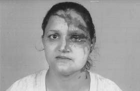 Sunita after the acid attack