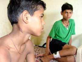 Akash and Tarun show injury marks after they were reportedly beaten up by their teachers at Arya Model School in Bathinda
