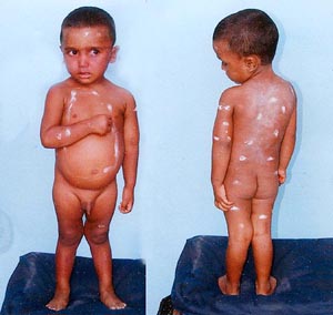 Luvpreet Singh shows his injuries.