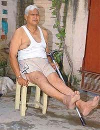 Dharam Chand, whose right leg shortened after he met with an accident, at his residence in Bajwara Kalan village near Hoshiarpur