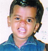 The girl child suspected of having polio