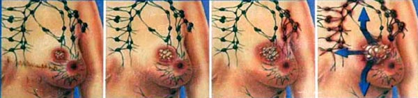 The diagram shows four stages of the progression of cancer