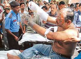 One of the victims from Meerut undergoes treatment at Safderjung Hospital, New Delhi, on Tuesday