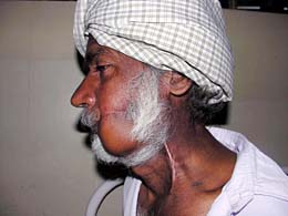 Balbir Singh, an oral cancer patient, with his face reconstructed at the DMCH in Ludhiana.