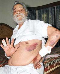 Mr Mal Singh Mann, owner of a house in Sector 19, shows injury marks on his body after he was assaulted by unidentified persons in Chandigarh