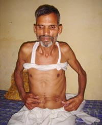 Surinder Kumar, an Indian spy, who has returned after remaining 15 years in Pakistani jails, shows scars he received at the hands of jail authorities there.
