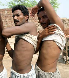 Two men show scars left on their bodies after they sold their kidneys in the Bhalwal area of Sargodha district in Pakistan on Thursday. There is no law in Pakistan banning the trade in organs.