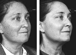 Before (left) and after the use of laser cosmetic procedure
