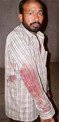 Mehar Singh shows his injured arm