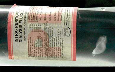 A bottle of fungus-infested intra-peritoneal dialysis fluid that raised many eyebrows at the PGI on Friday
