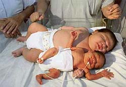 Antonio Cruz (top) is seen on Wednesday alongside an unidentified more averaged sized baby at a hospital in Mexicos resort city of Cancun.