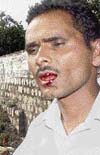 The RTOs driver who was allegedly beaten up by taxi operators at Dharamsala on Saturday