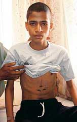 Eleven-year-old Rajnish, who got a new lease of life after a heart surgery, having a routine check-up at Hero DMC Heart Institute in Ludhiana on Wednesday. 